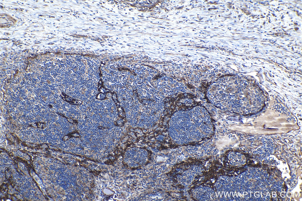 Immunohistochemical analysis of paraffin-embedded human lymphoma tissue slide using KHC1127 (CLEC4M IHC Kit).