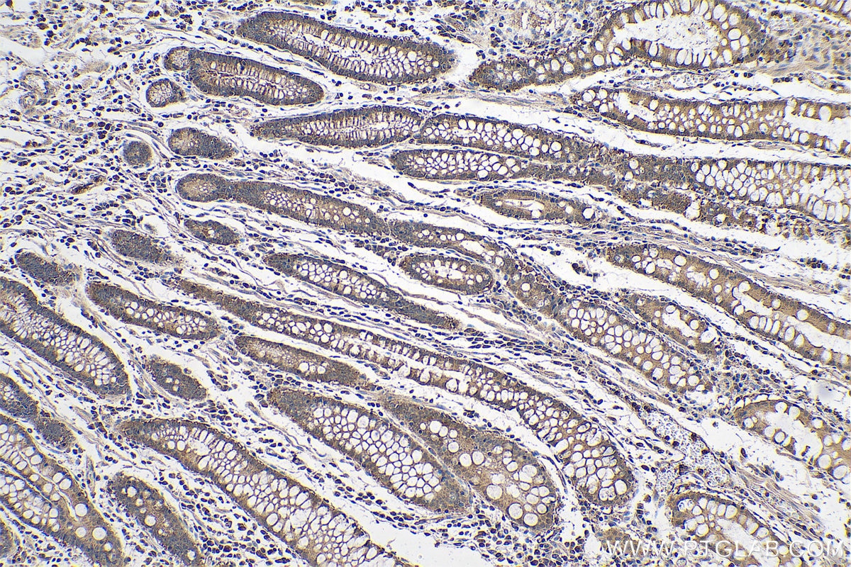 Immunohistochemical analysis of paraffin-embedded human stomach cancer tissue slide using KHC0725 (CLIC1 IHC Kit).