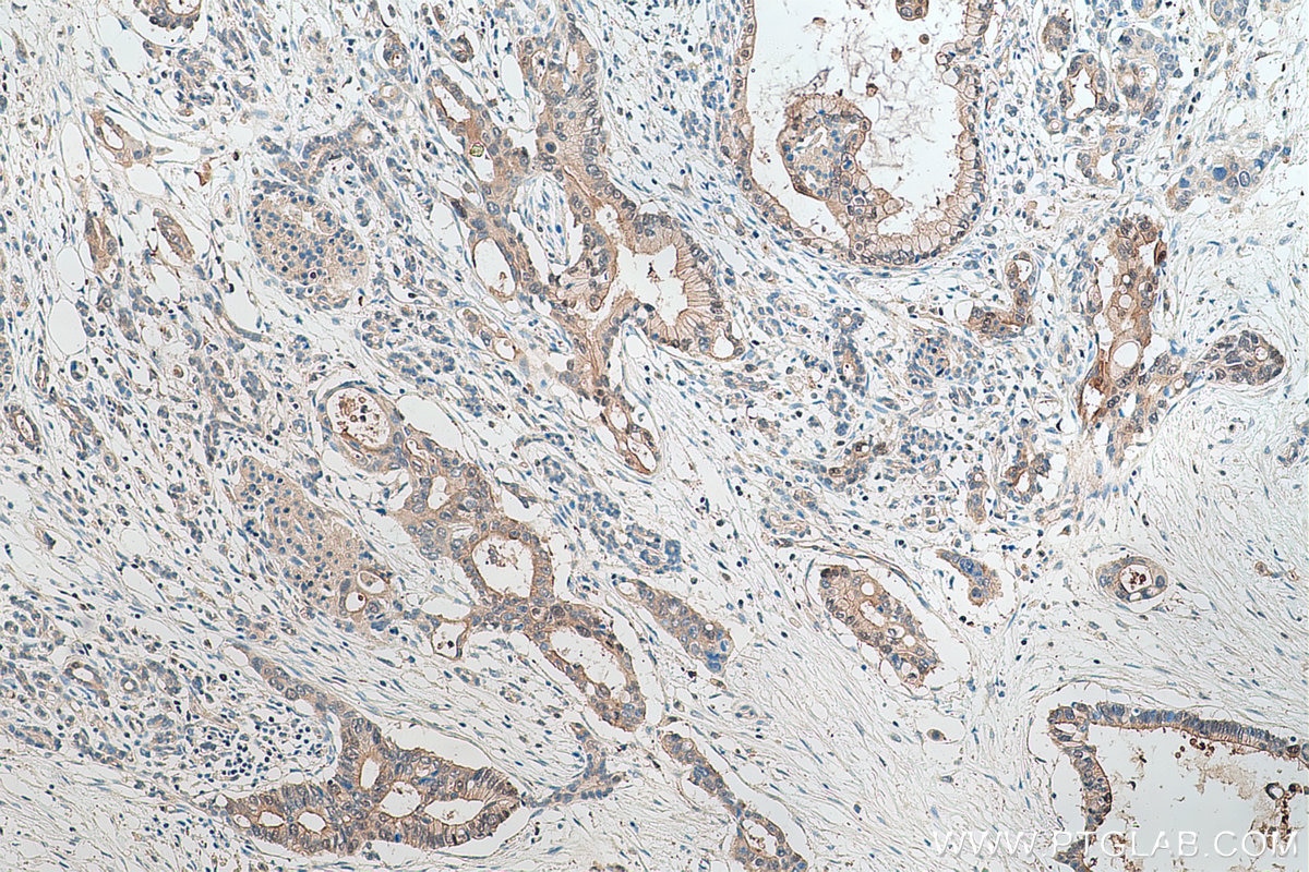 Immunohistochemical analysis of paraffin-embedded human pancreas cancer tissue slide using KHC0725 (CLIC1 IHC Kit).