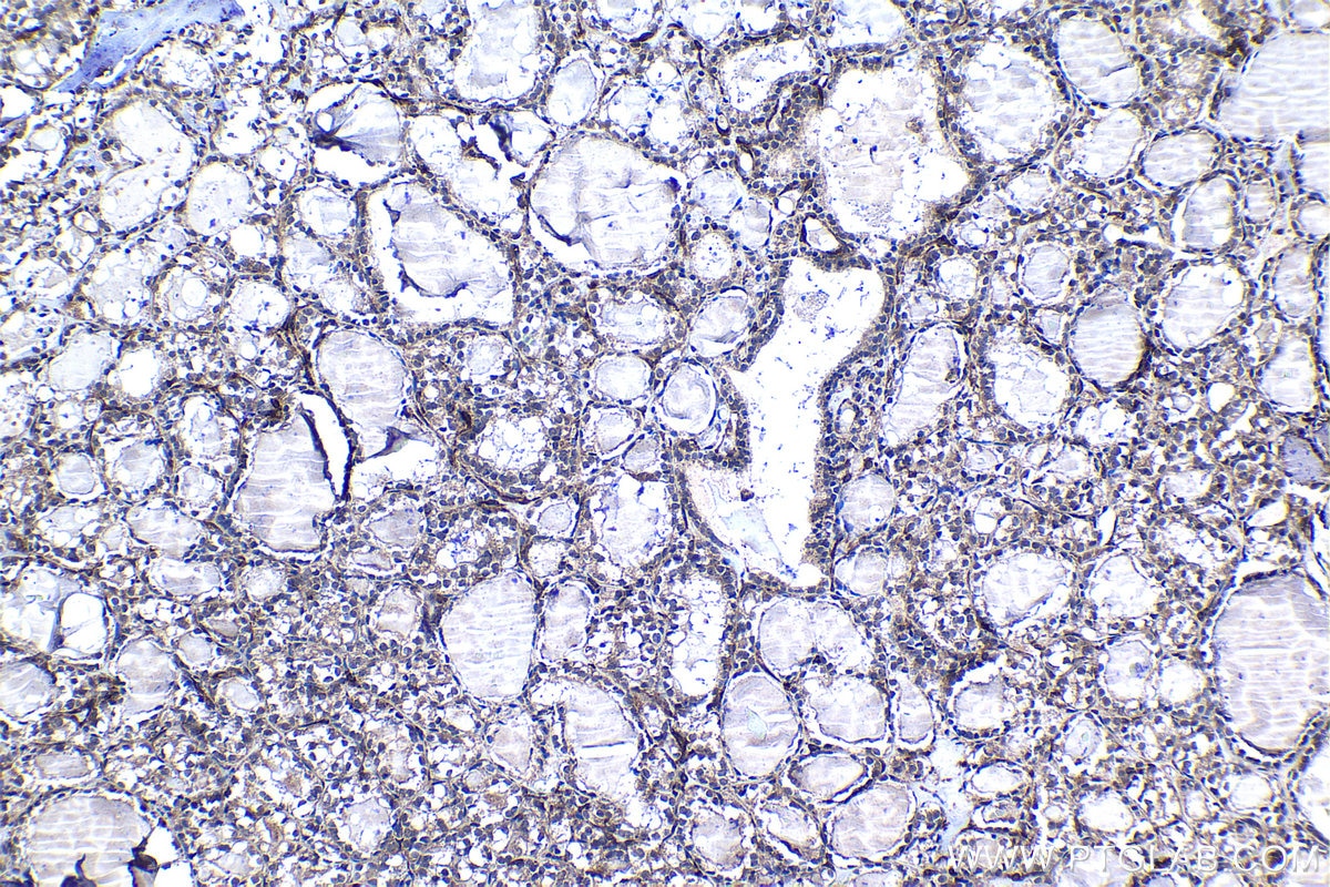 Immunohistochemical analysis of paraffin-embedded human thyroid cancer tissue slide using KHC1272 (CLIP2 IHC Kit).