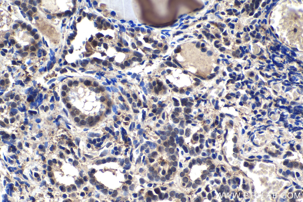 Immunohistochemical analysis of paraffin-embedded human thyroid cancer tissue slide using KHC1447 (CLOCK IHC Kit).