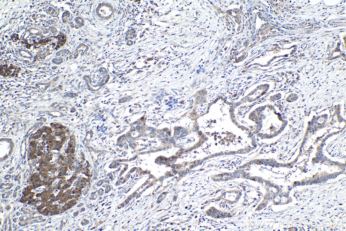 Immunohistochemical analysis of paraffin-embedded human pancreas cancer tissue slide using KHC1447 (CLOCK IHC Kit).