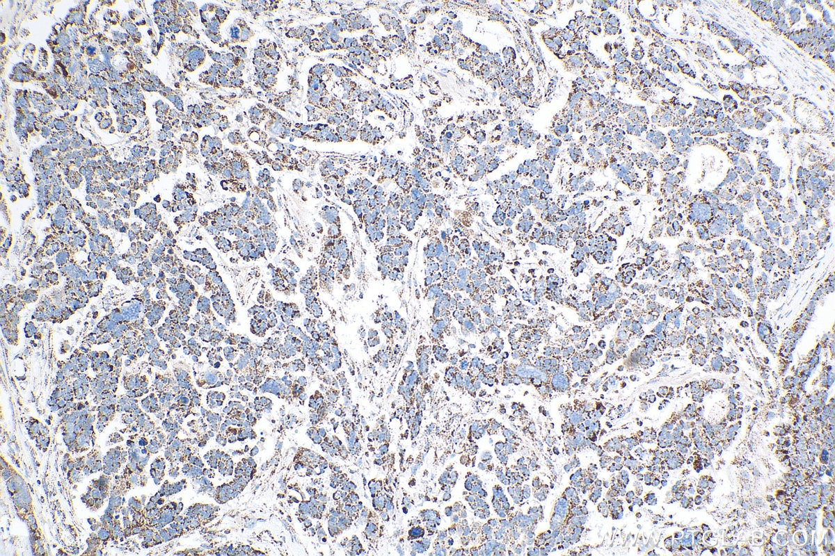 Immunohistochemical analysis of paraffin-embedded human colon cancer tissue slide using KHC0816 (CLPP IHC Kit).