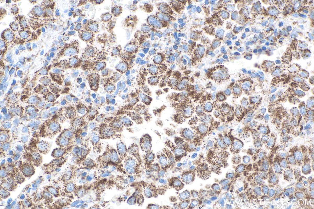 Immunohistochemical analysis of paraffin-embedded human lung cancer tissue slide using KHC0816 (CLPP IHC Kit).
