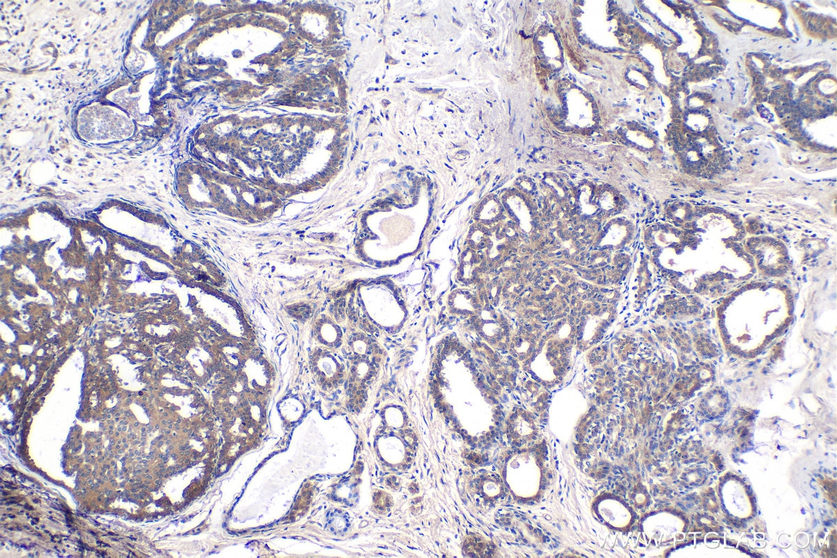 Immunohistochemical analysis of paraffin-embedded human breast cancer tissue slide using KHC1359 (CLSTN1 IHC Kit).