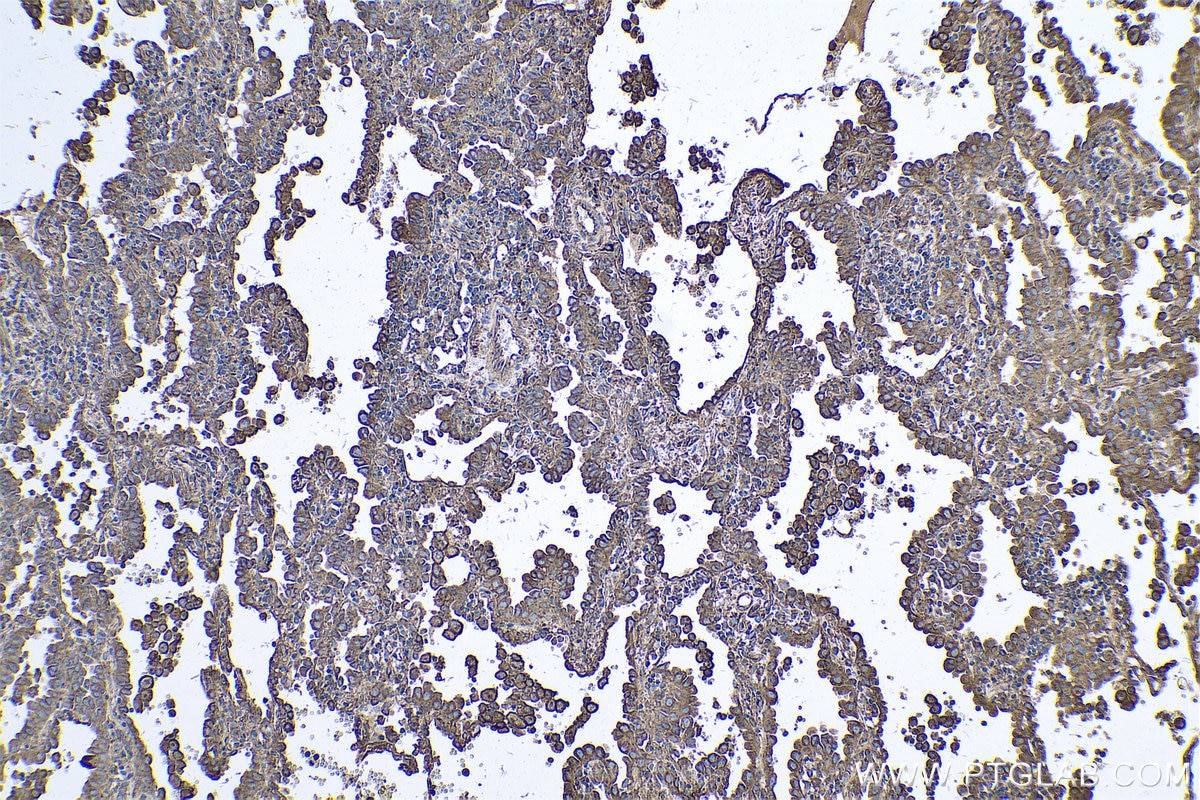 Immunohistochemical analysis of paraffin-embedded human lung cancer tissue slide using KHC0592 (CLTA IHC Kit).