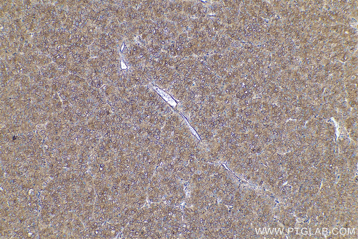 Immunohistochemical analysis of paraffin-embedded human liver cancer tissue slide using KHC0592 (CLTA IHC Kit).