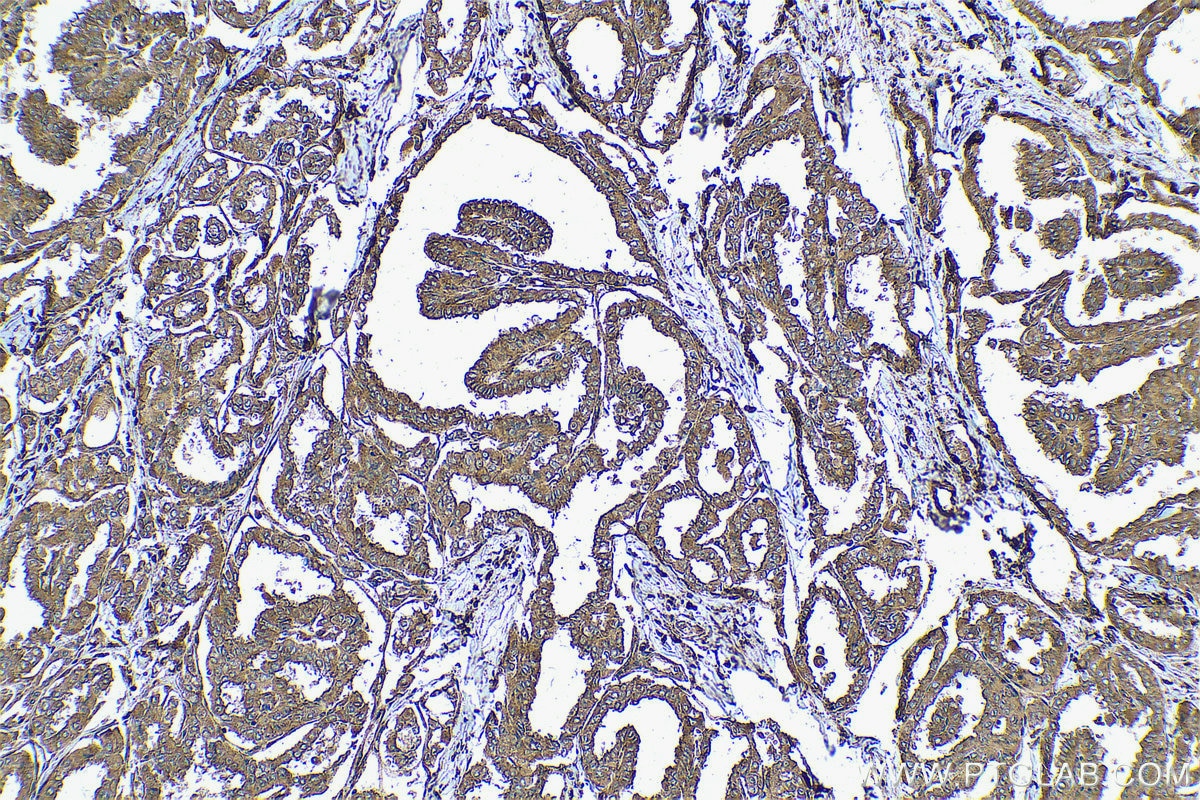 Immunohistochemical analysis of paraffin-embedded human thyroid cancer tissue slide using KHC0593 (CLTB IHC Kit).