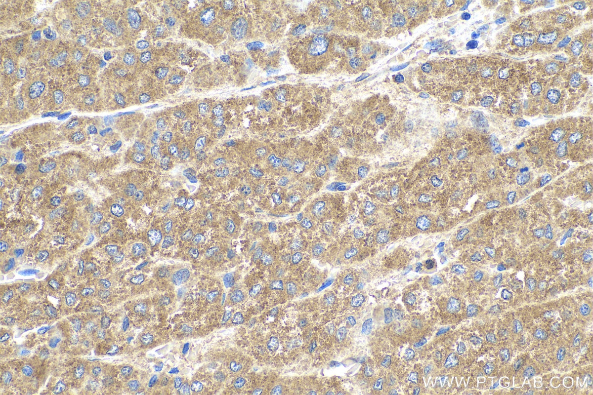 Immunohistochemical analysis of paraffin-embedded human liver cancer tissue slide using KHC0593 (CLTB IHC Kit).