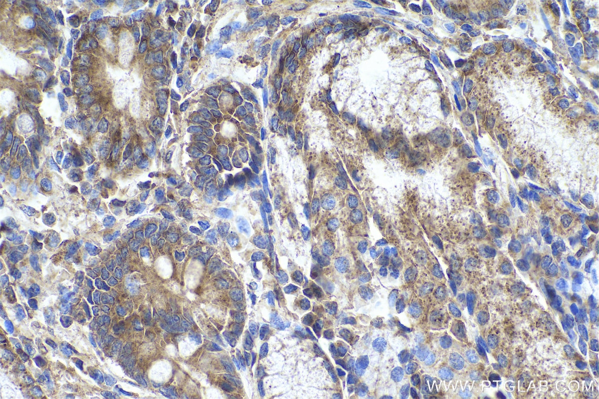 Immunohistochemical analysis of paraffin-embedded human stomach cancer tissue slide using KHC0687 (CLTC IHC Kit).