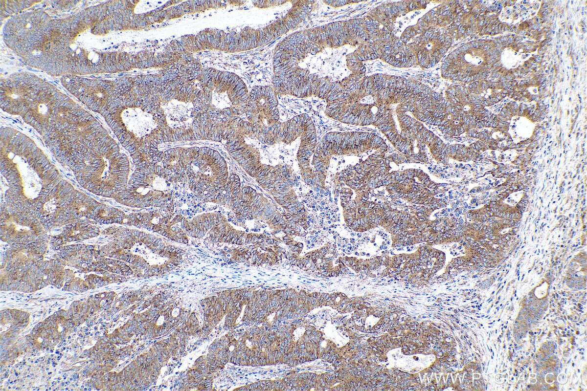 Immunohistochemical analysis of paraffin-embedded human colon cancer tissue slide using KHC0687 (CLTC IHC Kit).