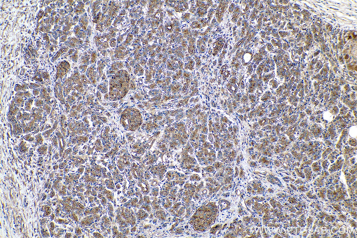 Immunohistochemical analysis of paraffin-embedded human pancreas cancer tissue slide using KHC0687 (CLTC IHC Kit).