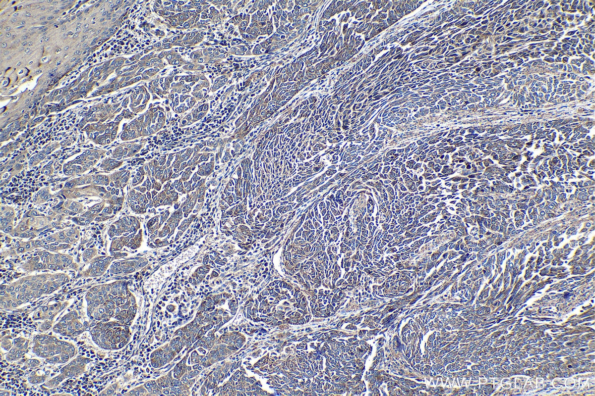 Immunohistochemical analysis of paraffin-embedded human oesophagus cancer tissue slide using KHC1392 (CLYBL IHC Kit).
