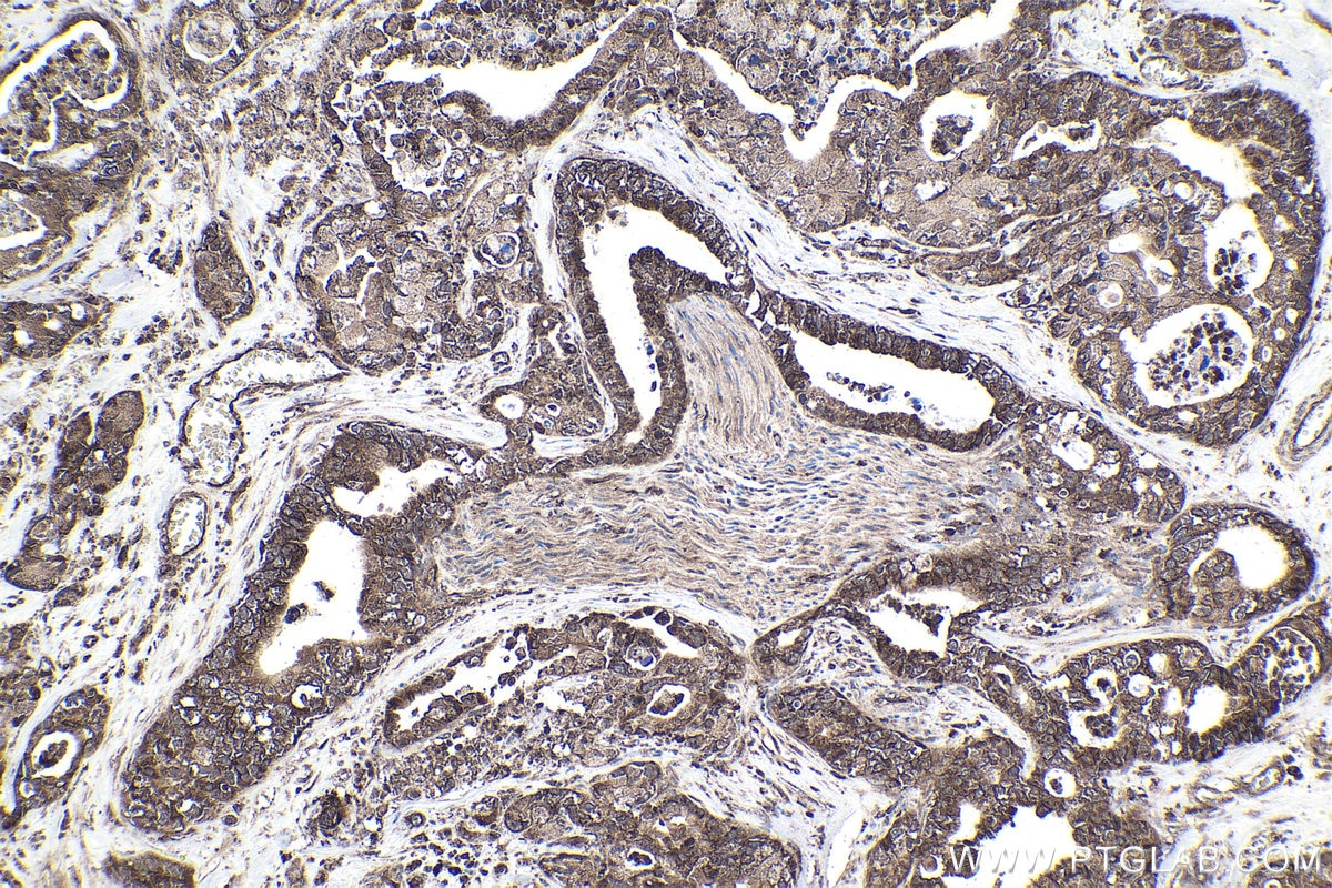 Immunohistochemical analysis of paraffin-embedded human pancreas cancer tissue slide using KHC1823 (CMIP IHC Kit).