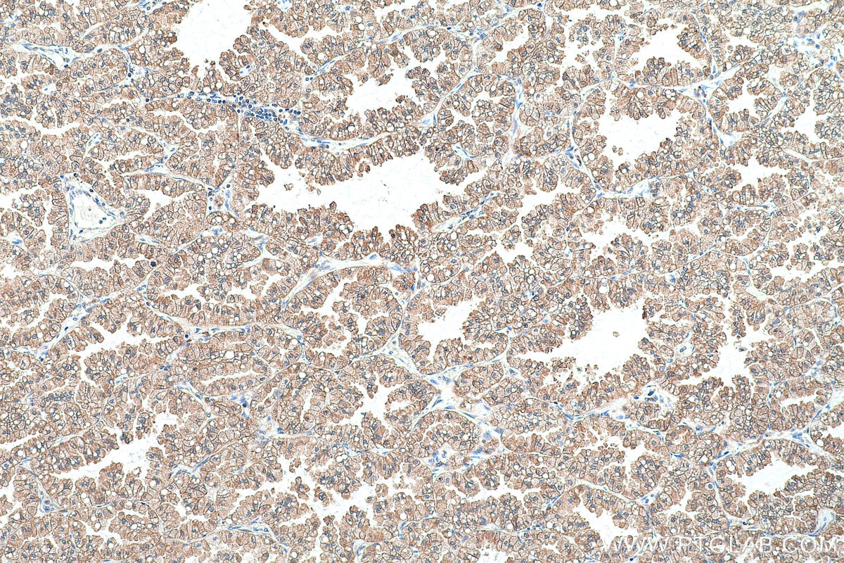 Immunohistochemical analysis of paraffin-embedded human lung cancer tissue slide using KHC0727 (CMPK1 IHC Kit).