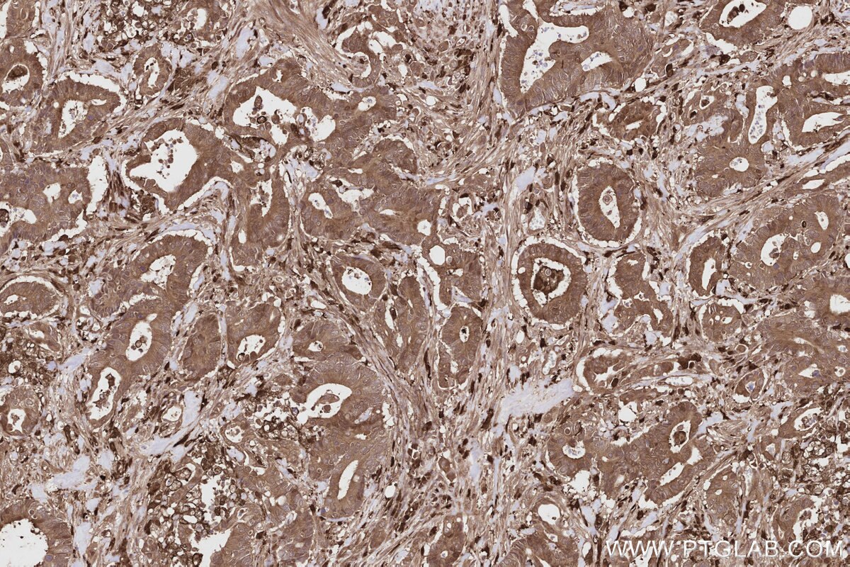 Immunohistochemical analysis of paraffin-embedded human rectal cancer tissue slide using KHC2804 (CNDP2 IHC Kit).