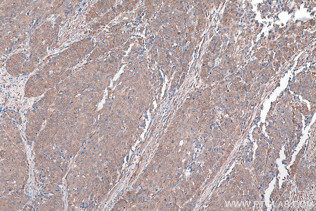 Immunohistochemical analysis of paraffin-embedded human stomach cancer tissue slide using KHC0892 (CNN3 IHC Kit).