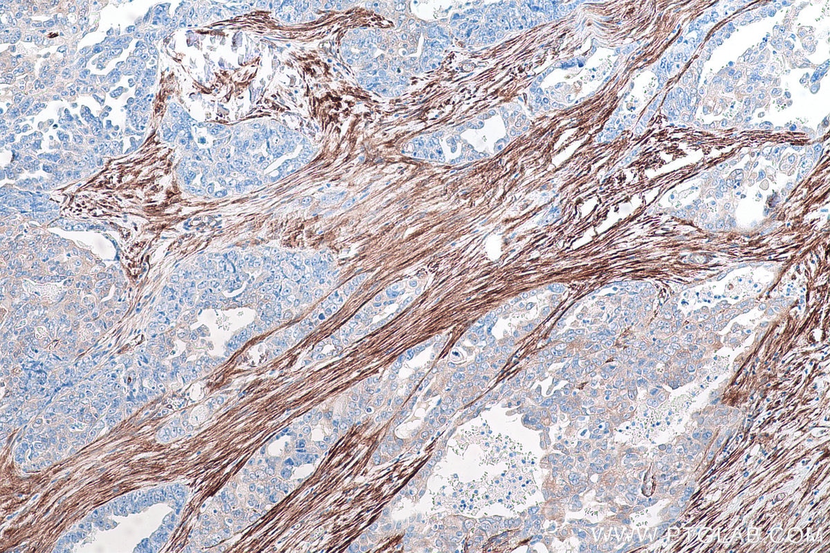 Immunohistochemical analysis of paraffin-embedded human ovary tumor tissue slide using KHC0892 (CNN3 IHC Kit).