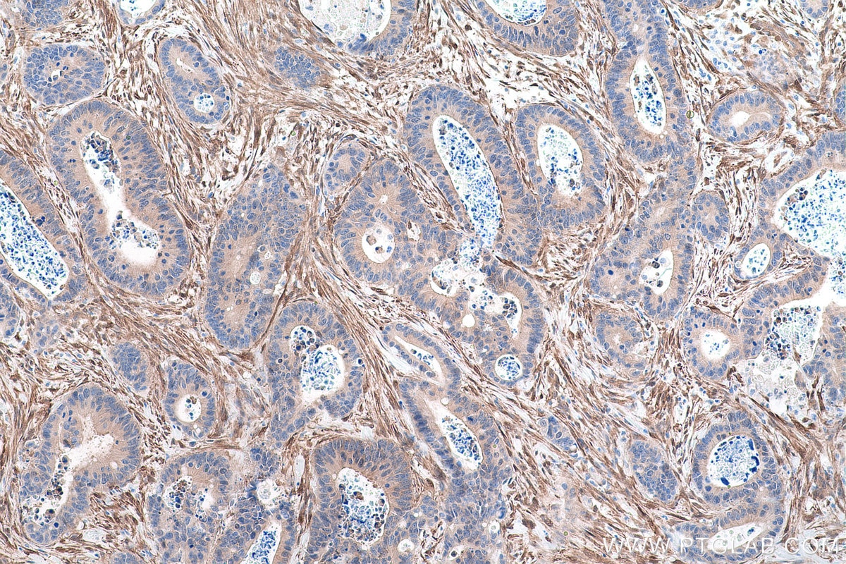 Immunohistochemical analysis of paraffin-embedded human colon cancer tissue slide using KHC0892 (CNN3 IHC Kit).