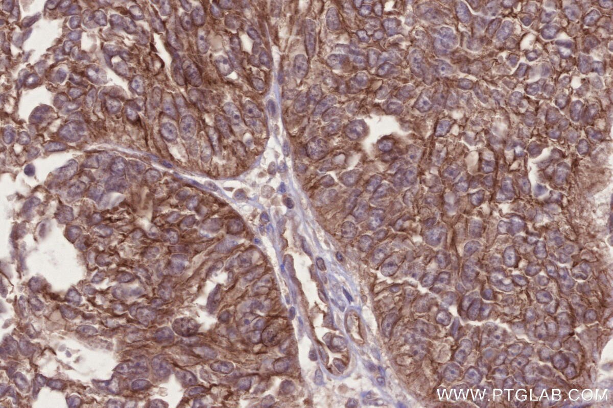 Immunohistochemical analysis of paraffin-embedded human ovary cancer tissue slide using KHC2690 (CNNM3 IHC Kit).