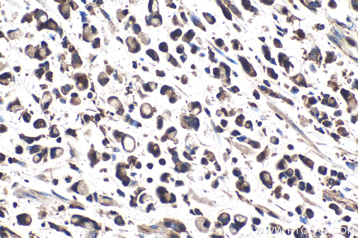 Immunohistochemical analysis of paraffin-embedded human stomach cancer tissue slide using KHC1415 (CNOT1 IHC Kit).