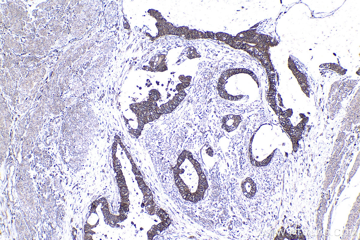 Immunohistochemical analysis of paraffin-embedded human urothelial carcinoma tissue slide using KHC1471 (CNOT3 IHC Kit).