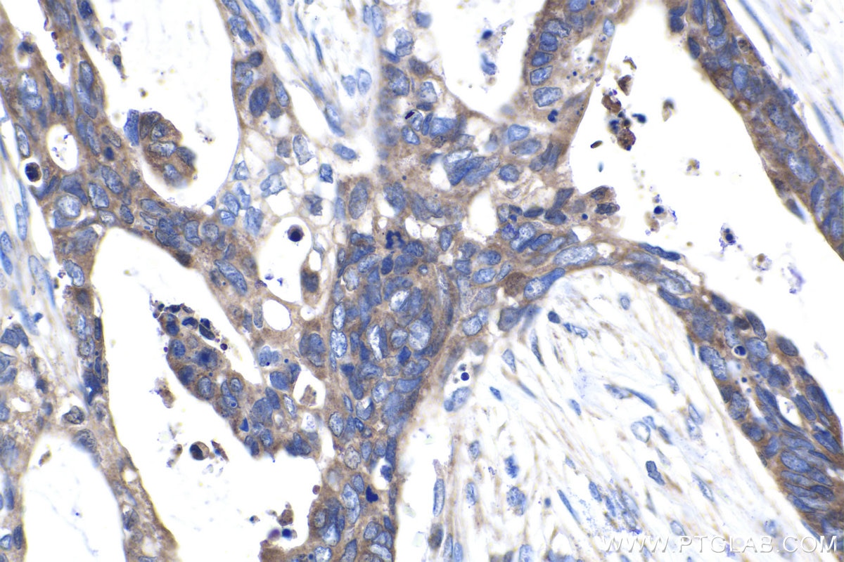Immunohistochemical analysis of paraffin-embedded human urothelial carcinoma tissue slide using KHC1497 (CNOT4 IHC Kit).