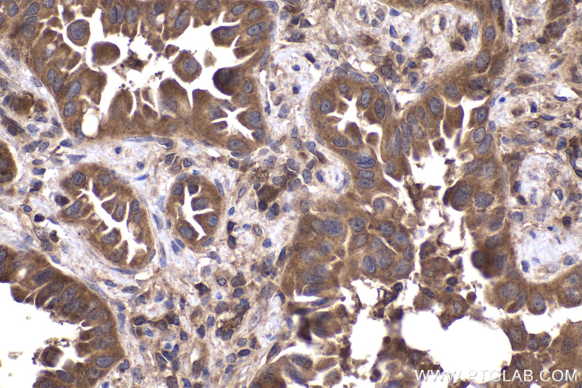 Immunohistochemical analysis of paraffin-embedded human lung cancer tissue slide using KHC1978 (CNOT8 IHC Kit).