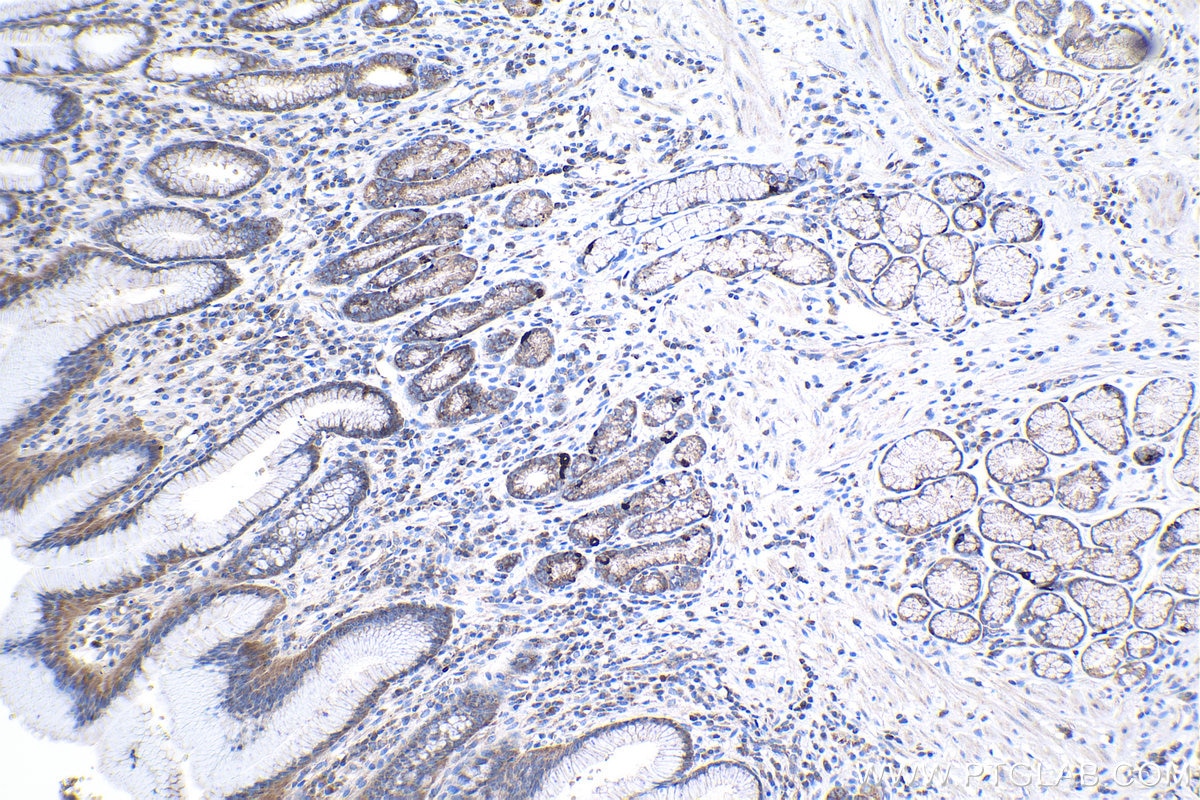 Immunohistochemical analysis of paraffin-embedded human stomach cancer tissue slide using KHC0999 (CNOT9 IHC Kit).