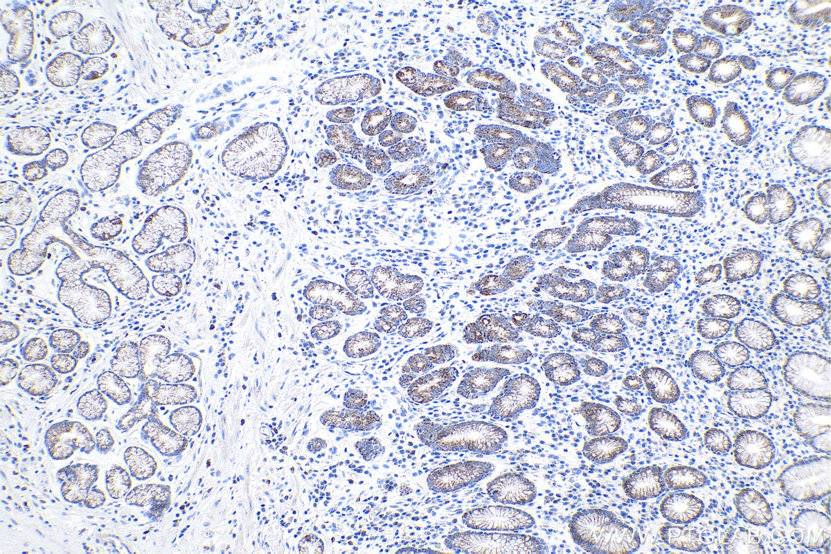 Immunohistochemical analysis of paraffin-embedded human stomach cancer tissue slide using KHC1023 (COA6 IHC Kit).