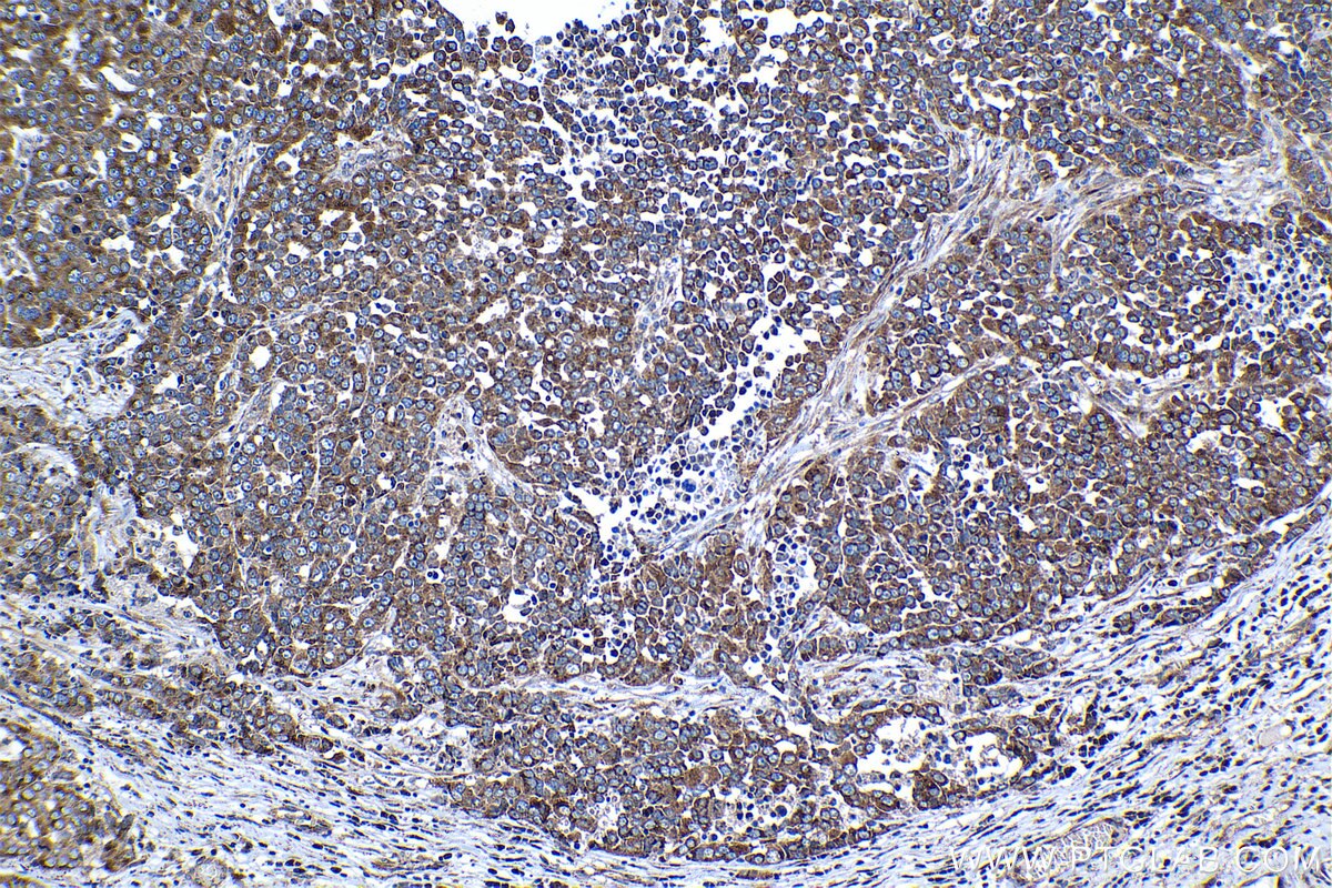 Immunohistochemical analysis of paraffin-embedded human ovary tumor tissue slide using KHC1292 (COG3 IHC Kit).