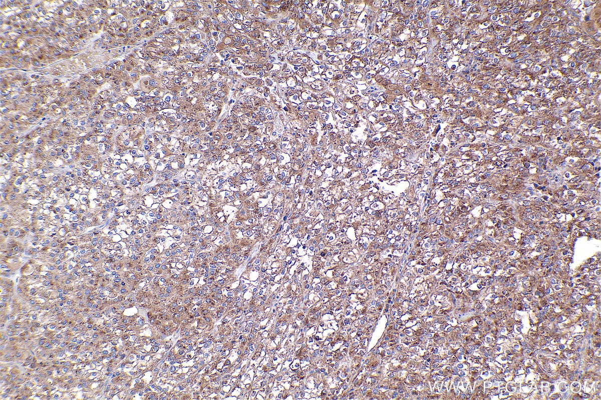 Immunohistochemical analysis of paraffin-embedded human endometrial cancer tissue slide using KHC2371 (COG7 IHC Kit).