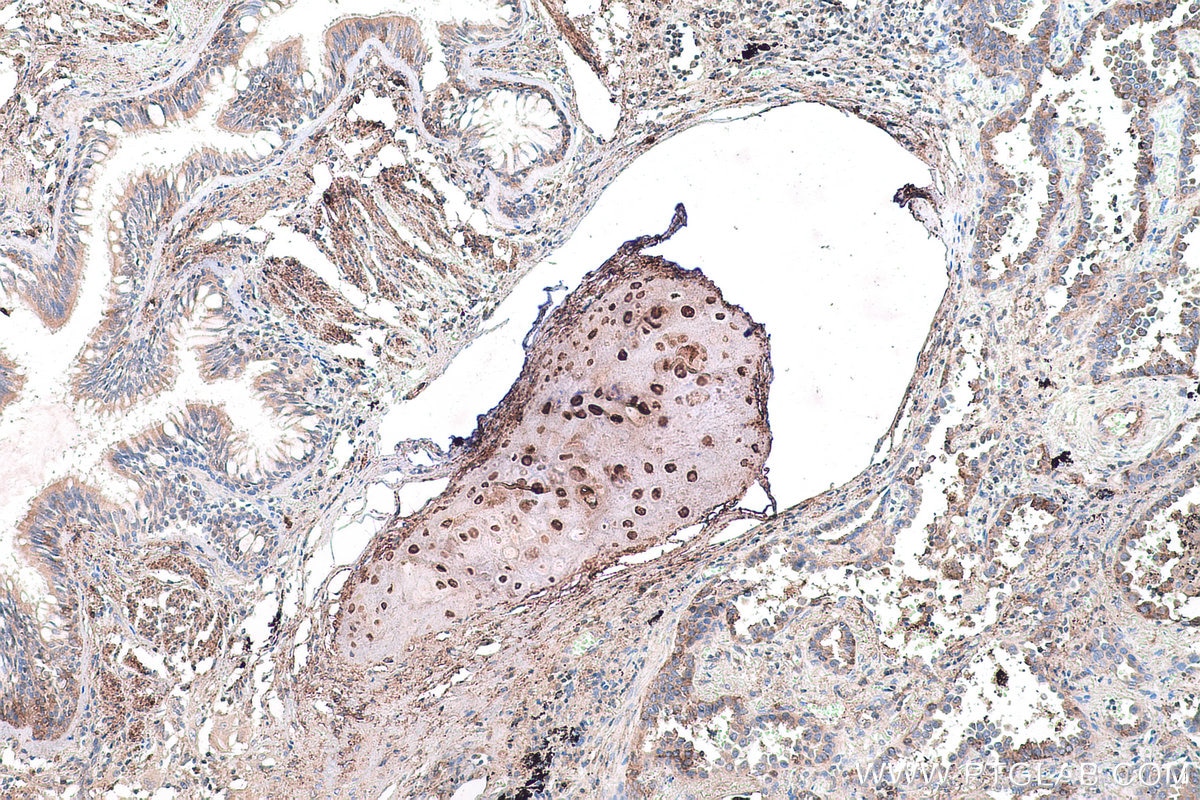 Immunohistochemical analysis of paraffin-embedded human lung cancer tissue slide using KHC0743 (COL10A1 IHC Kit).