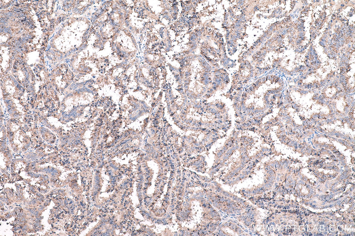 Immunohistochemical analysis of paraffin-embedded human ovary tumor tissue slide using KHC0743 (COL10A1 IHC Kit).