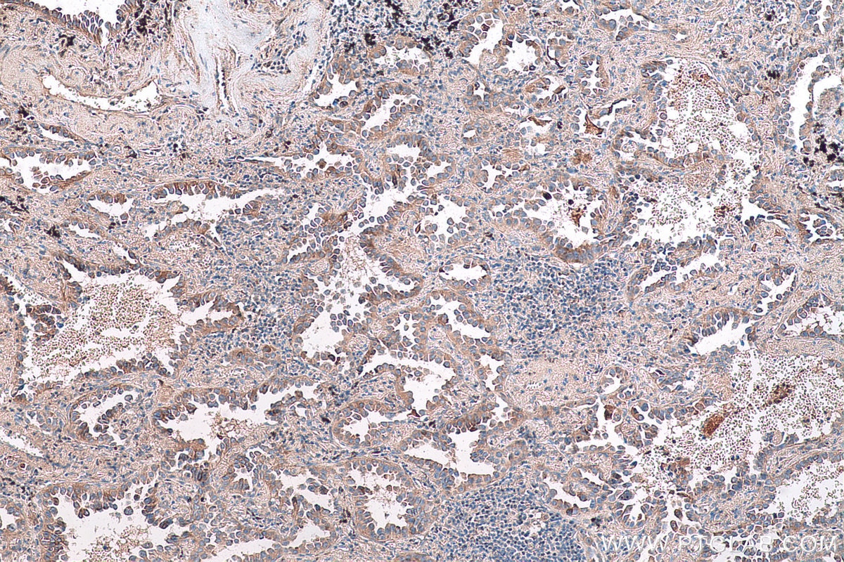 Immunohistochemical analysis of paraffin-embedded human lung cancer tissue slide using KHC0744 (COL11A1 IHC Kit).