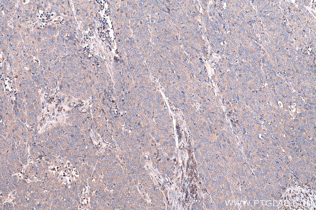 Immunohistochemical analysis of paraffin-embedded human stomach cancer tissue slide using KHC0744 (COL11A1 IHC Kit).