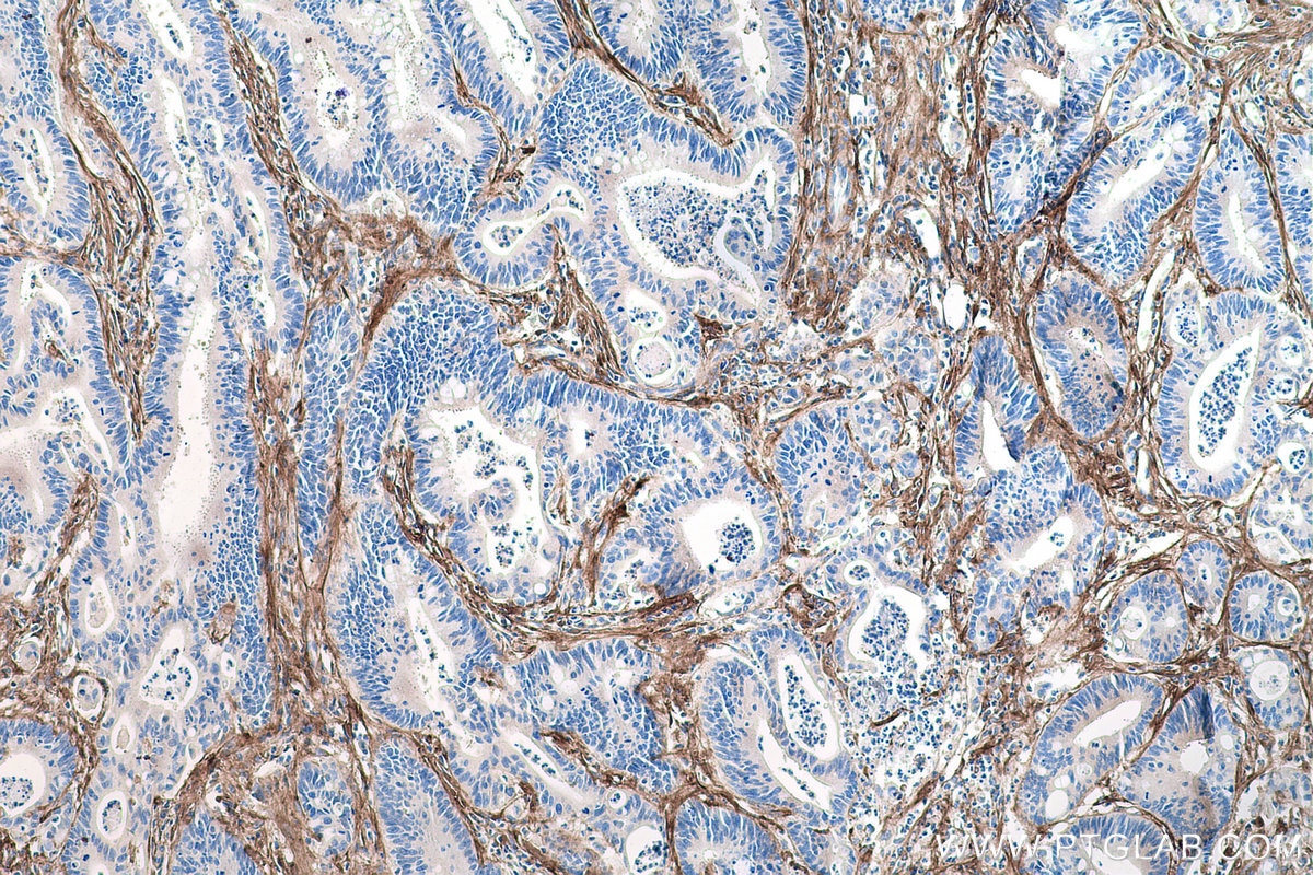 Immunohistochemical analysis of paraffin-embedded human colon cancer tissue slide using KHC0205 (COL1A1 IHC Kit).