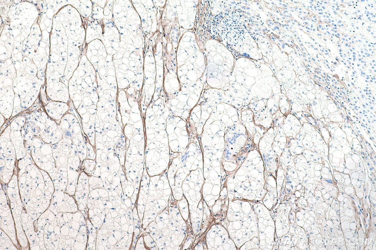 Immunohistochemical analysis of paraffin-embedded human liver cancer tissue slide using KHC0205 (COL1A1 IHC Kit).