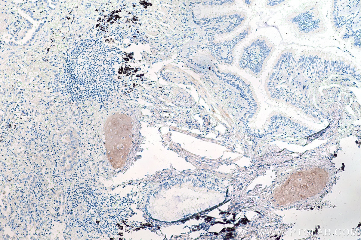 Immunohistochemical analysis of paraffin-embedded human lung cancer tissue slide using KHC0206 (Collagen Type II IHC Kit).