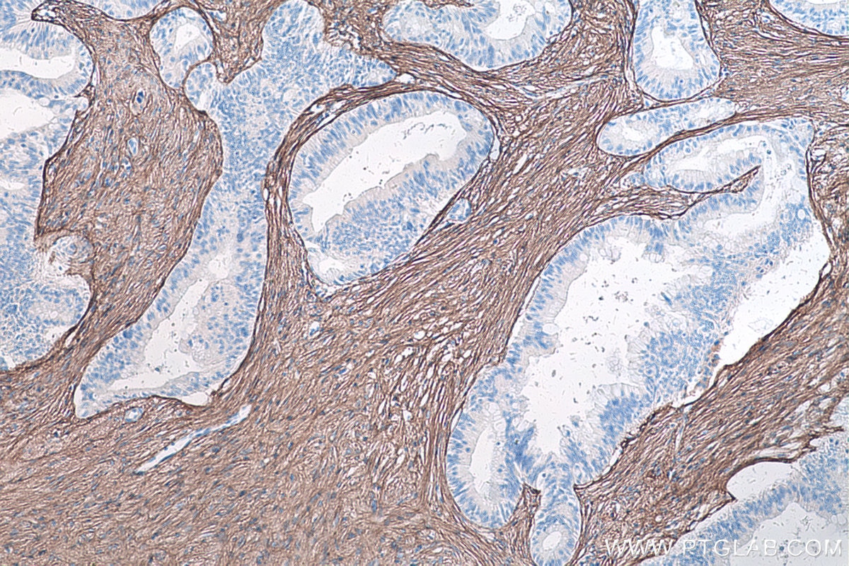 Immunohistochemical analysis of paraffin-embedded human pancreas cancer tissue slide using KHC0264 (COL3A1 IHC Kit).