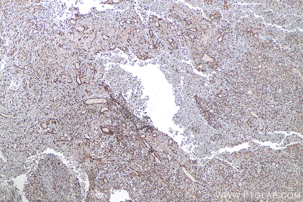 Immunohistochemical analysis of paraffin-embedded human colon cancer tissue slide using KHC0742 (COL5A1 IHC Kit).