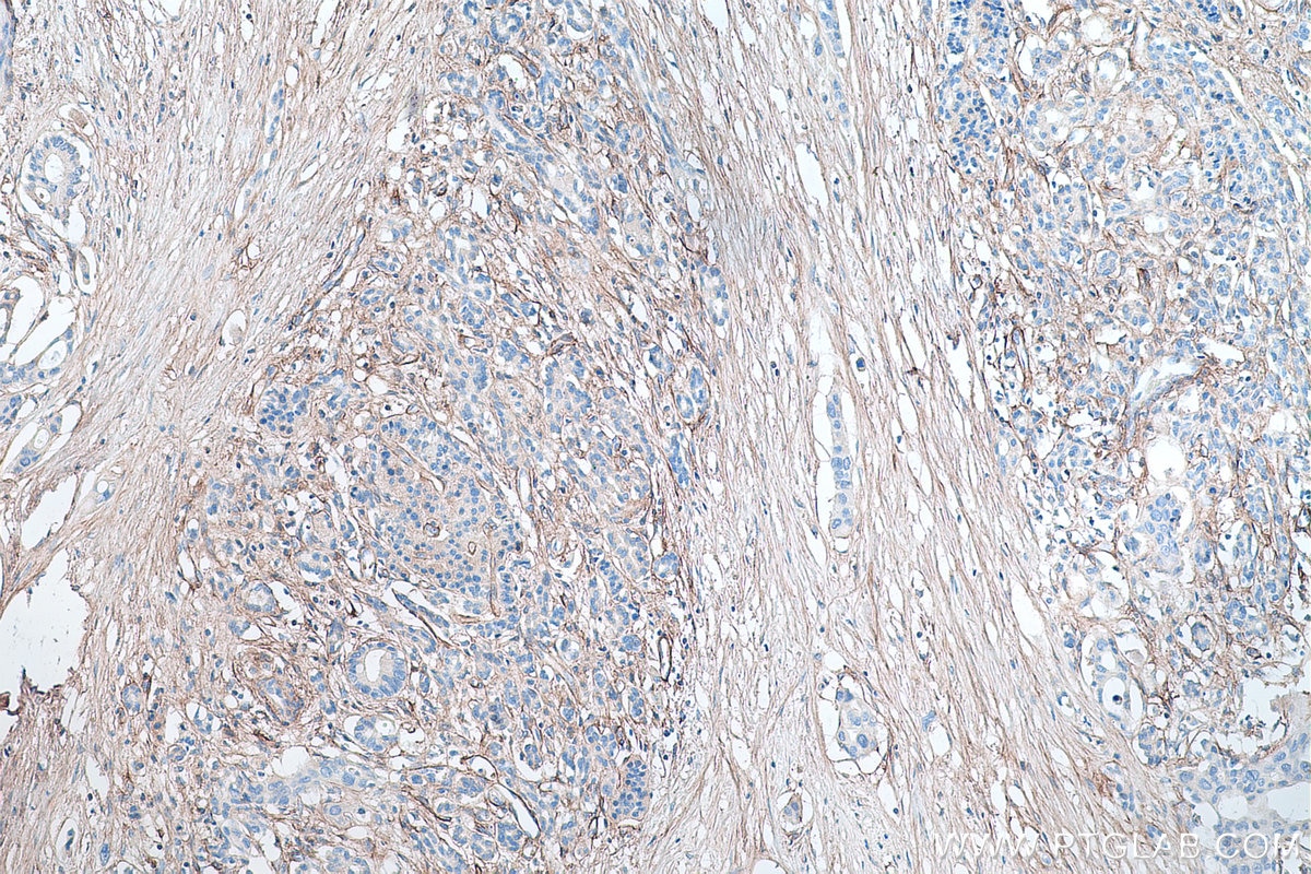 Immunohistochemical analysis of paraffin-embedded human pancreas cancer tissue slide using KHC0314 (COL6A1 IHC Kit).