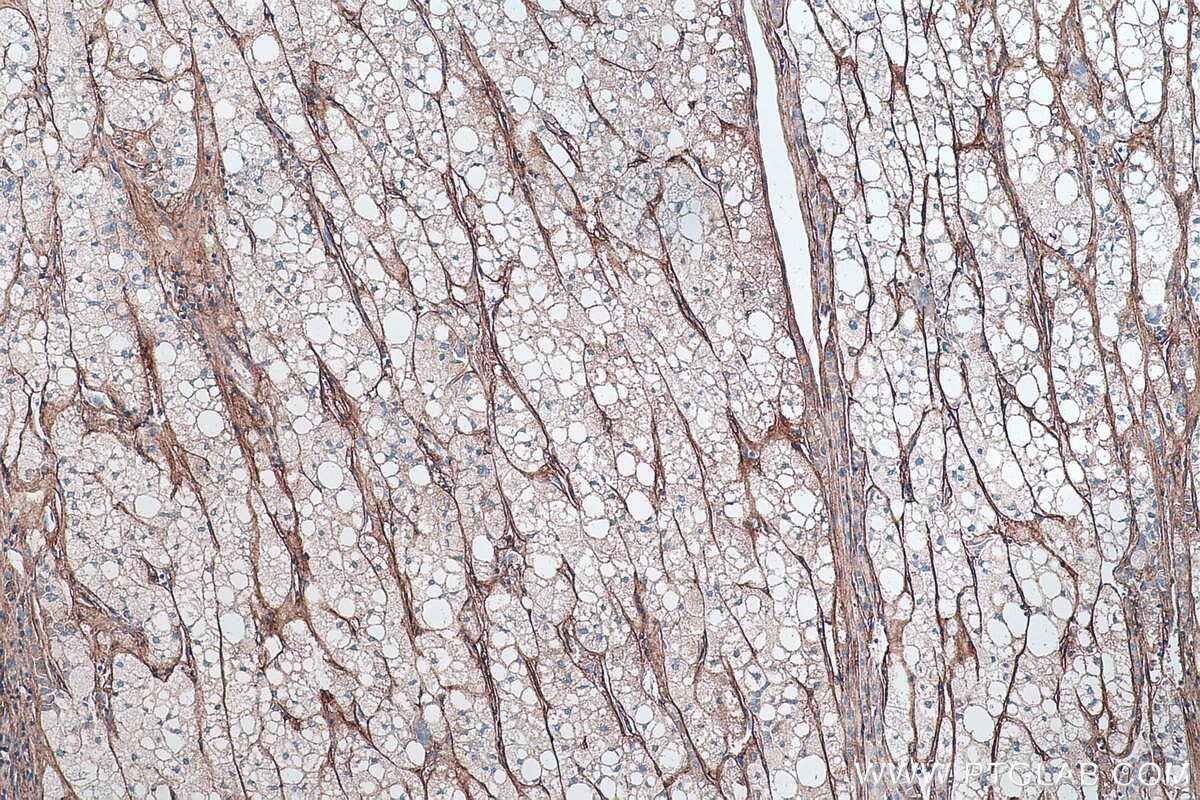 Immunohistochemical analysis of paraffin-embedded human liver cancer tissue slide using KHC0315 (COL6A2 IHC Kit).