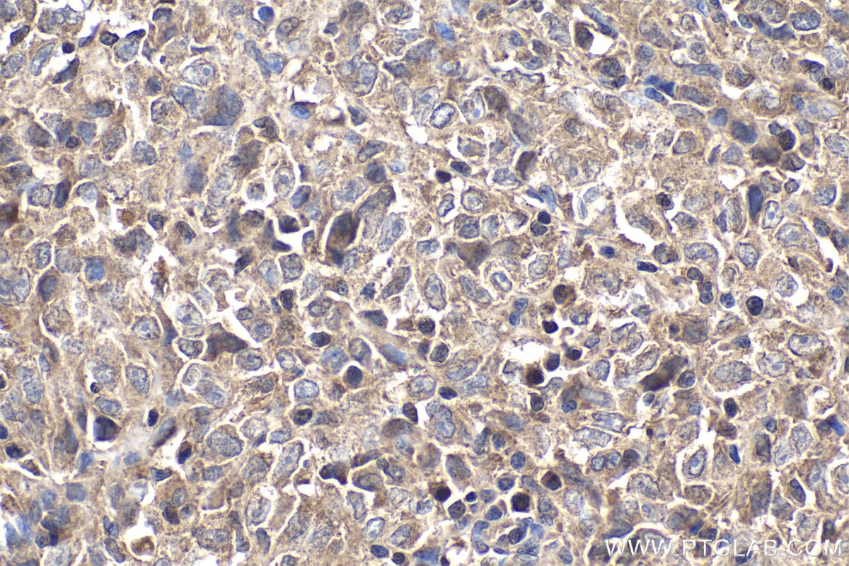 Immunohistochemical analysis of paraffin-embedded human malignant melanoma tissue slide using KHC1832 (COMMD1 IHC Kit).