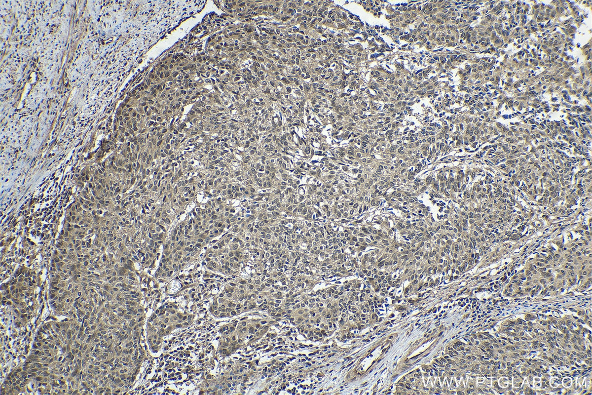 Immunohistochemical analysis of paraffin-embedded human cervical cancer tissue slide using KHC1639 (COPS2 IHC Kit).