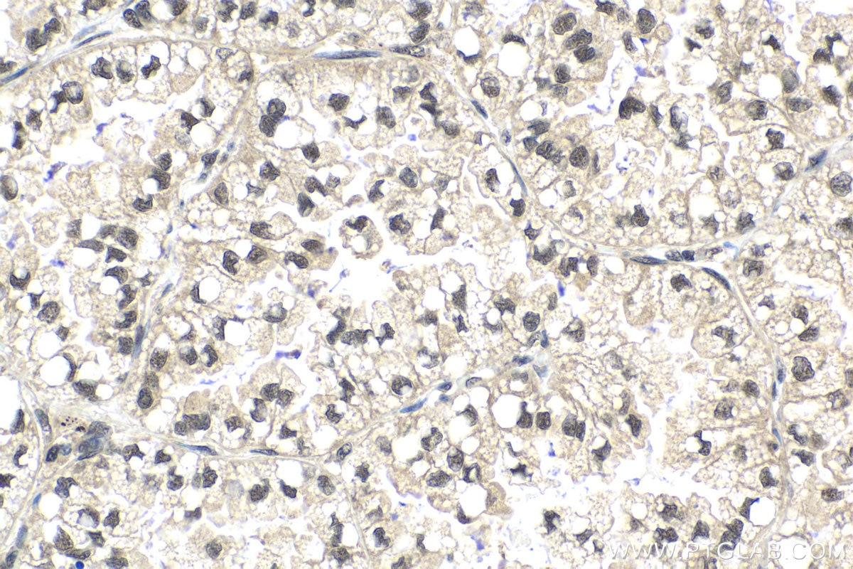 Immunohistochemical analysis of paraffin-embedded human lung cancer tissue slide using KHC2006 (COPS3 IHC Kit).