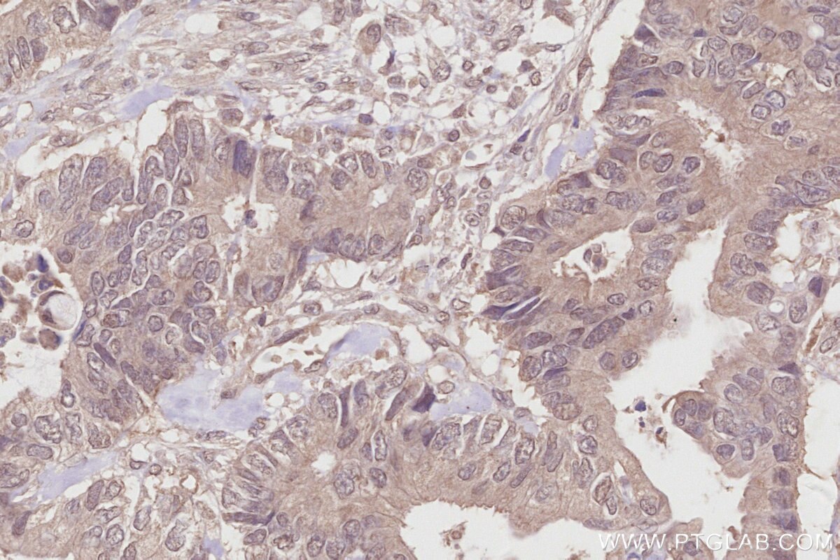 Immunohistochemical analysis of paraffin-embedded human rectal cancer tissue slide using KHC2864 (COPS4 IHC Kit).
