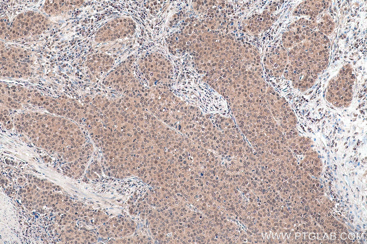 Immunohistochemical analysis of paraffin-embedded human stomach cancer tissue slide using KHC0921 (COPS5/JAB1 IHC Kit).