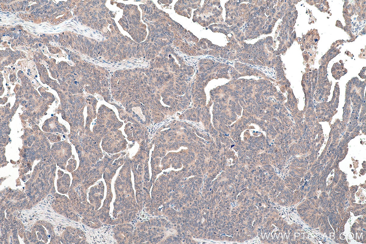 Immunohistochemical analysis of paraffin-embedded human ovary tumor tissue slide using KHC0921 (COPS5/JAB1 IHC Kit).