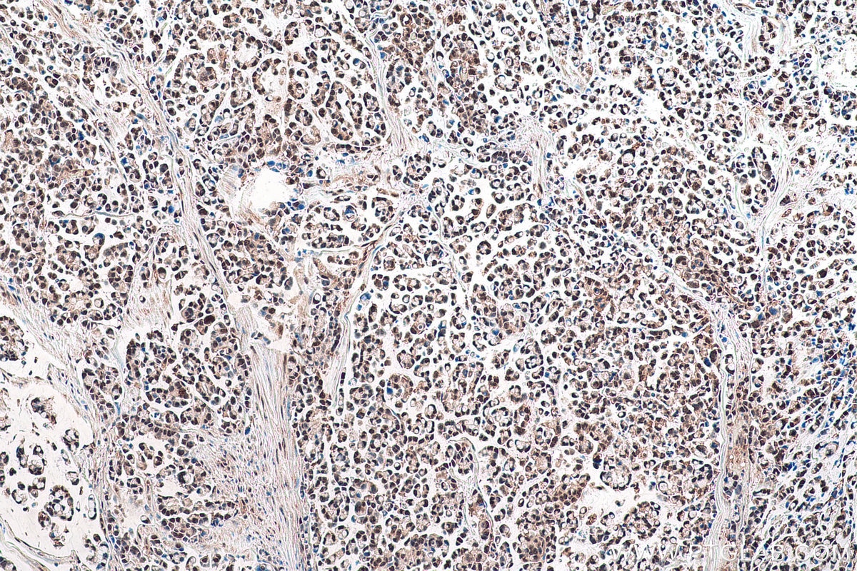 Immunohistochemical analysis of paraffin-embedded human colon cancer tissue slide using KHC0921 (COPS5/JAB1 IHC Kit).